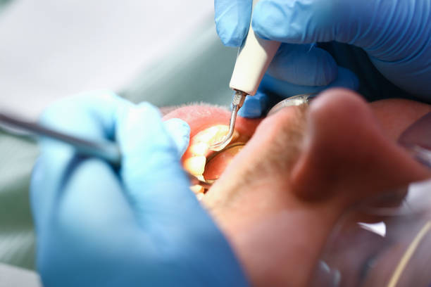 Best Emergency Root Canal Treatment in Murraysville, NC